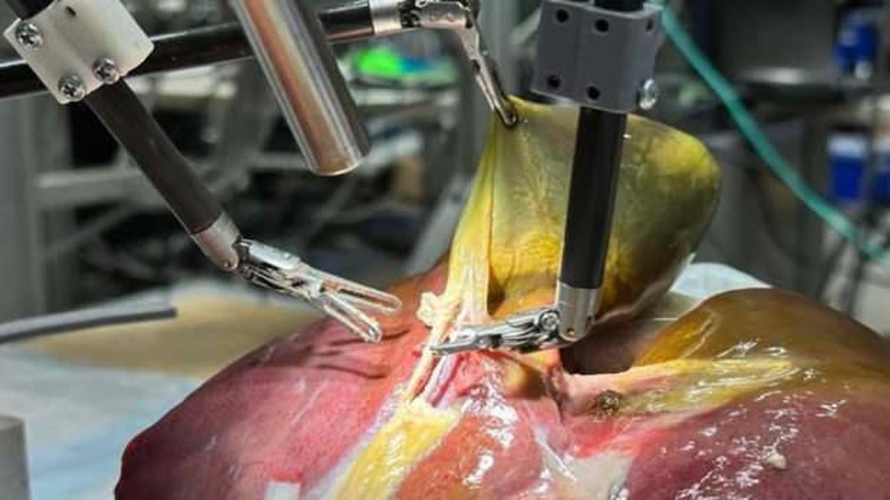 Ameliyatlar değişiyor! Tarihte ilk kez bir robot, yardım almadan gerçekleştirdi!